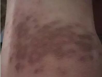 皮肤炎症后遗留的色素沉着该如何治疗 皮肤医美吕宇 微信公众号文章阅读 Wemp