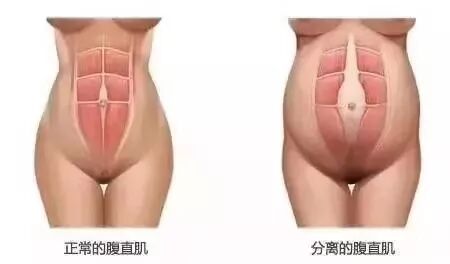 腹直肌修复 | 我来教你产后修复小技巧