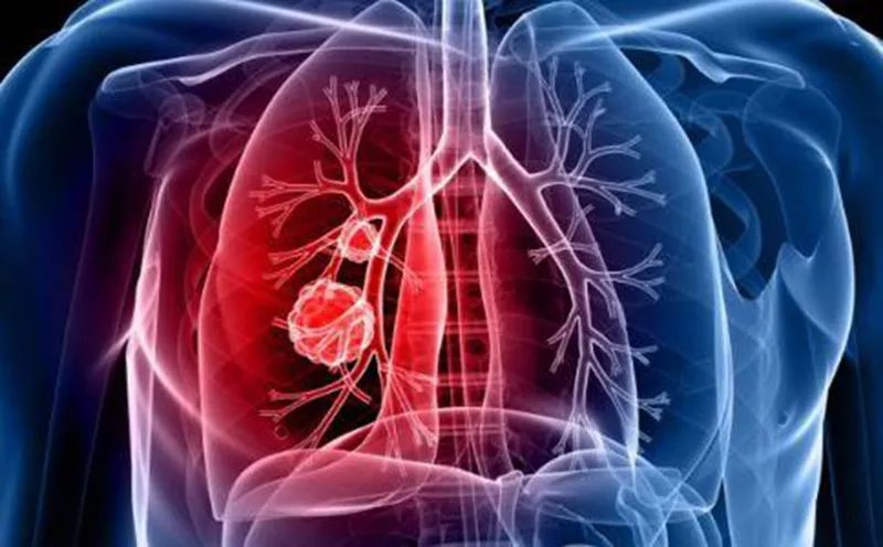 肺癌从早期到晚期通常会多久？晚期有哪些表现？这些问题你考虑过吗