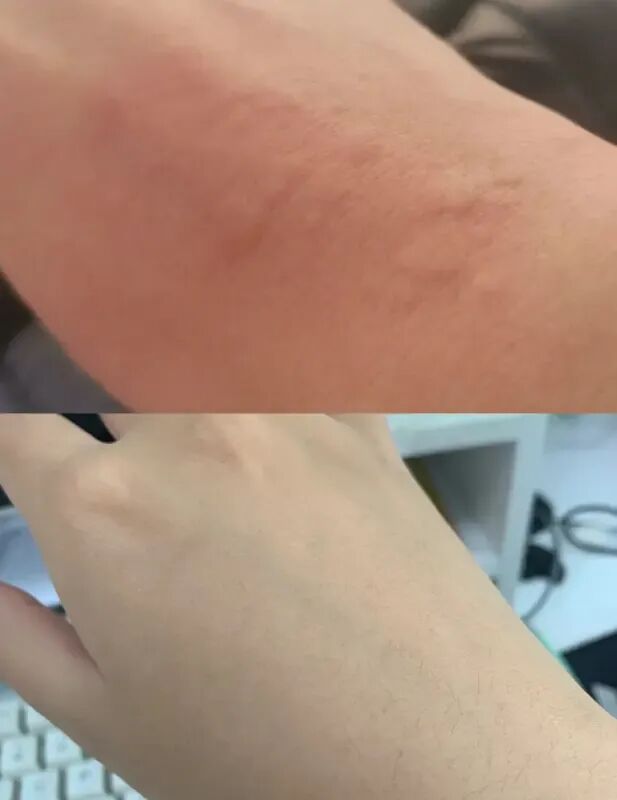 荨麻疹的症状和图片！长荨麻疹的家人们真的要小心啦！