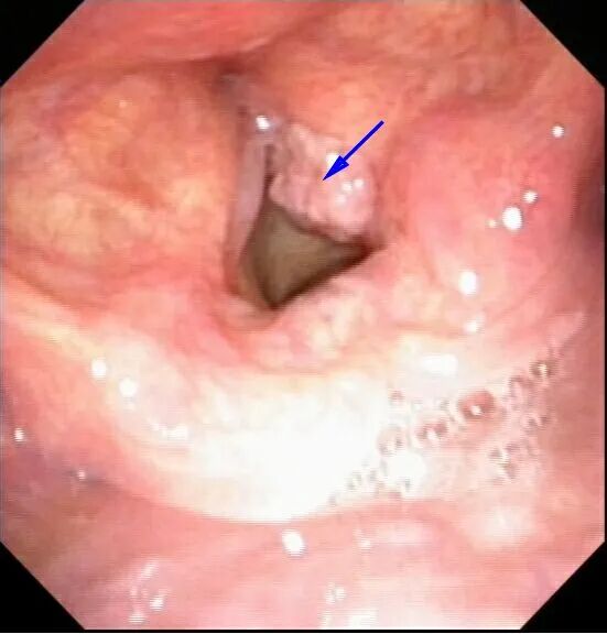 声音嘶哑没在意，一查竟是癌！幸好这个手术