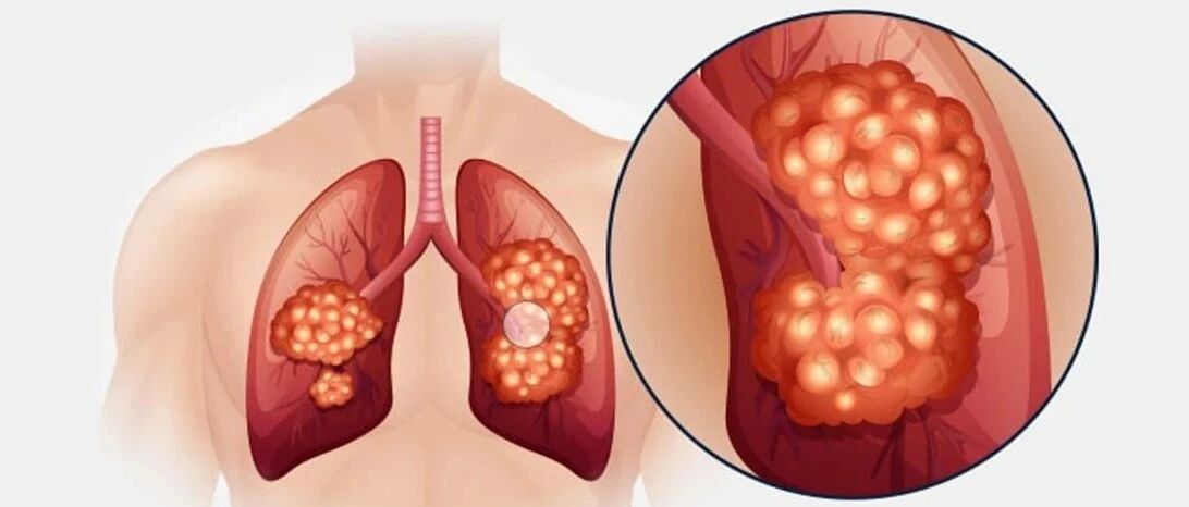 JTO | 赫捷院士团队：中国肺癌图鉴