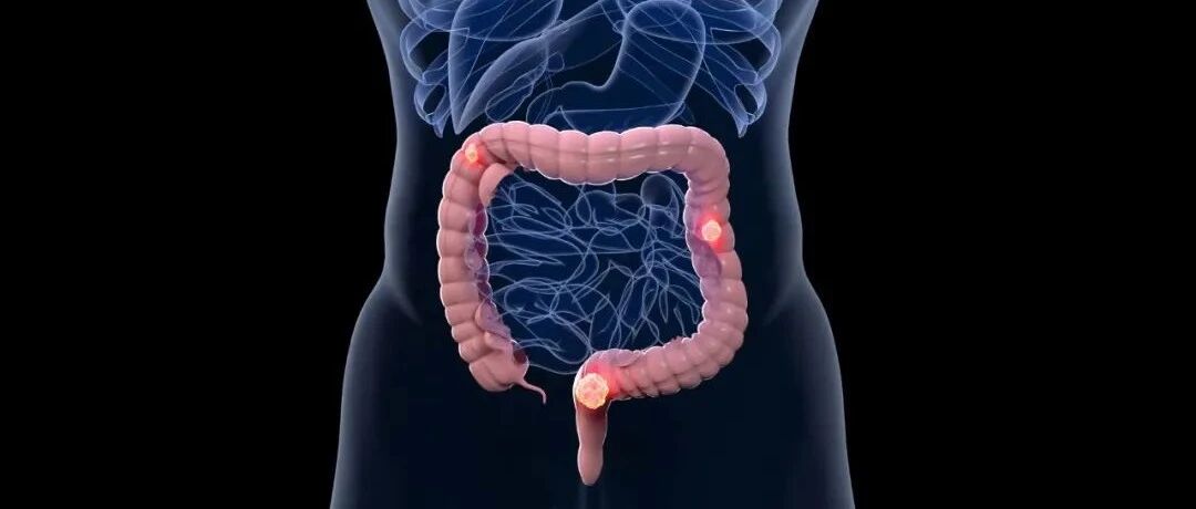 煜煜生辉：ERBB2阳性转移性结直肠癌研究进展盘点