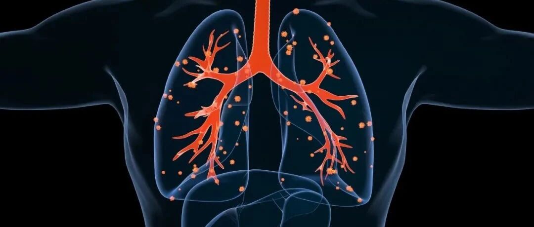 指南更新＆国际视角：两项研究促进ASCO指南快速更新，抗击肺癌又迈进一大步！