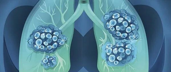 前沿进展 ｜ 局限性小细胞肺癌放化疗后纳武利尤单抗-伊匹木单抗双免巩固治疗