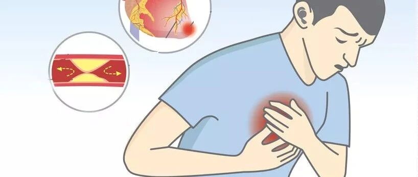 从"嗓子痛"到心肌死亡仅5天！！速效救心丸和硝酸甘油，谁才是救命药？