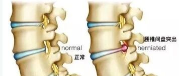 29岁小伙子腰痛后干这事，丁丁差点废了！男人腰不行，一切等于0