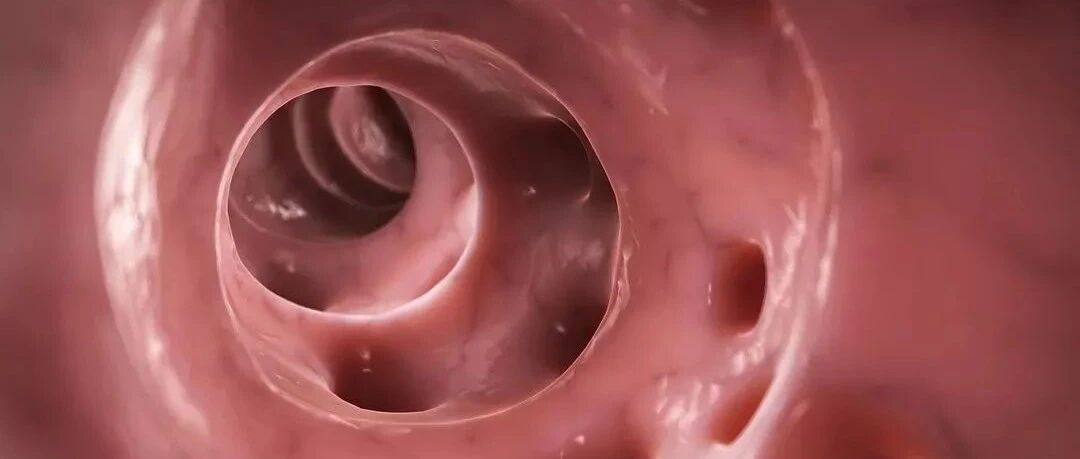 肠道里的"隐形杀手"——结肠憩室病