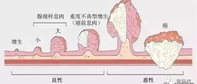 过了50岁，好多人都会有肠息肉——怎么才能阻断它癌变呢？