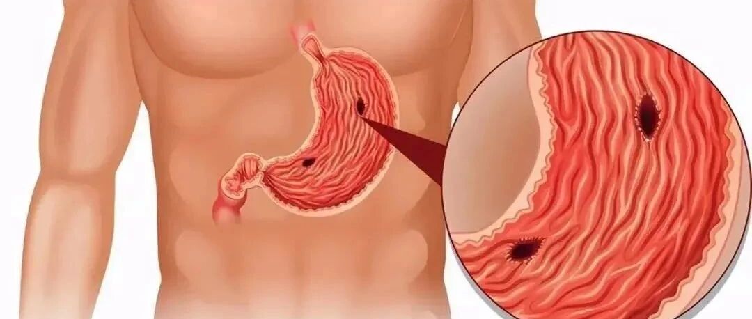 胃痛、胃胀没当回事，32岁男子因偶然一次黑便查出胃癌！