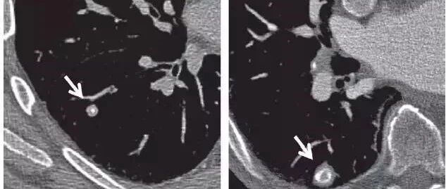 “肺部小结节”是肺癌的前兆？看完你就清楚了……