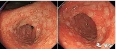 胃黏膜肠化生：一种癌前病变的防治