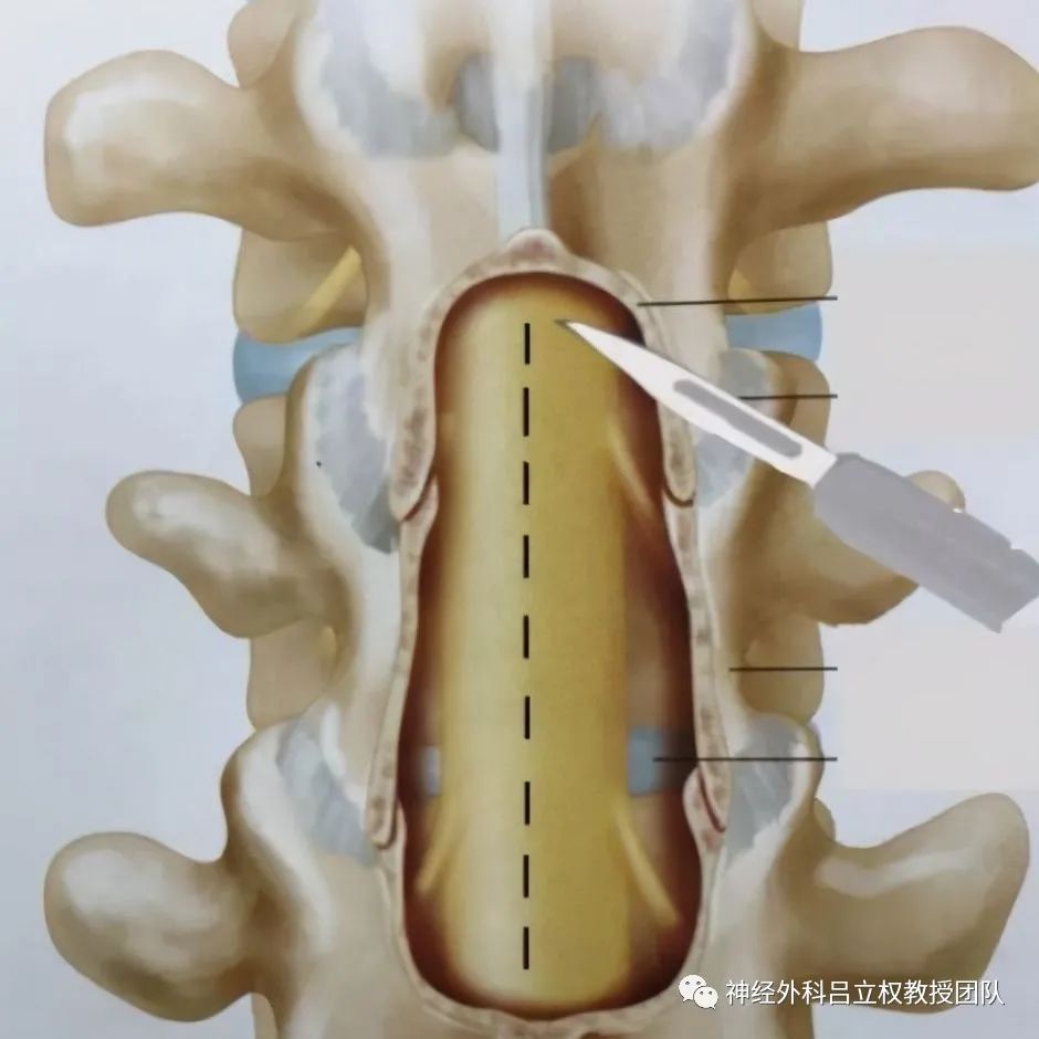 腰疼腿麻就是椎間盤突出還得當心是個瘤