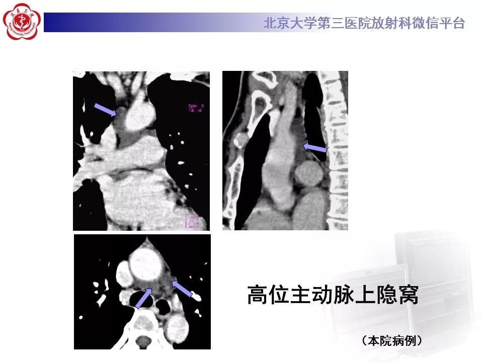 心包窦及心包隐窝的解剖结构