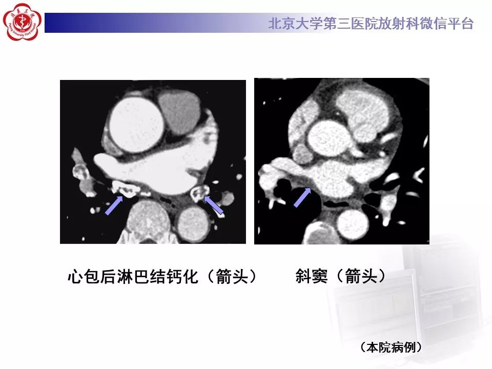 心包窦及心包隐窝的解剖结构