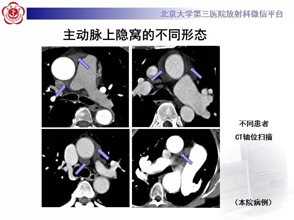 心包窦及心包隐窝的解剖结构