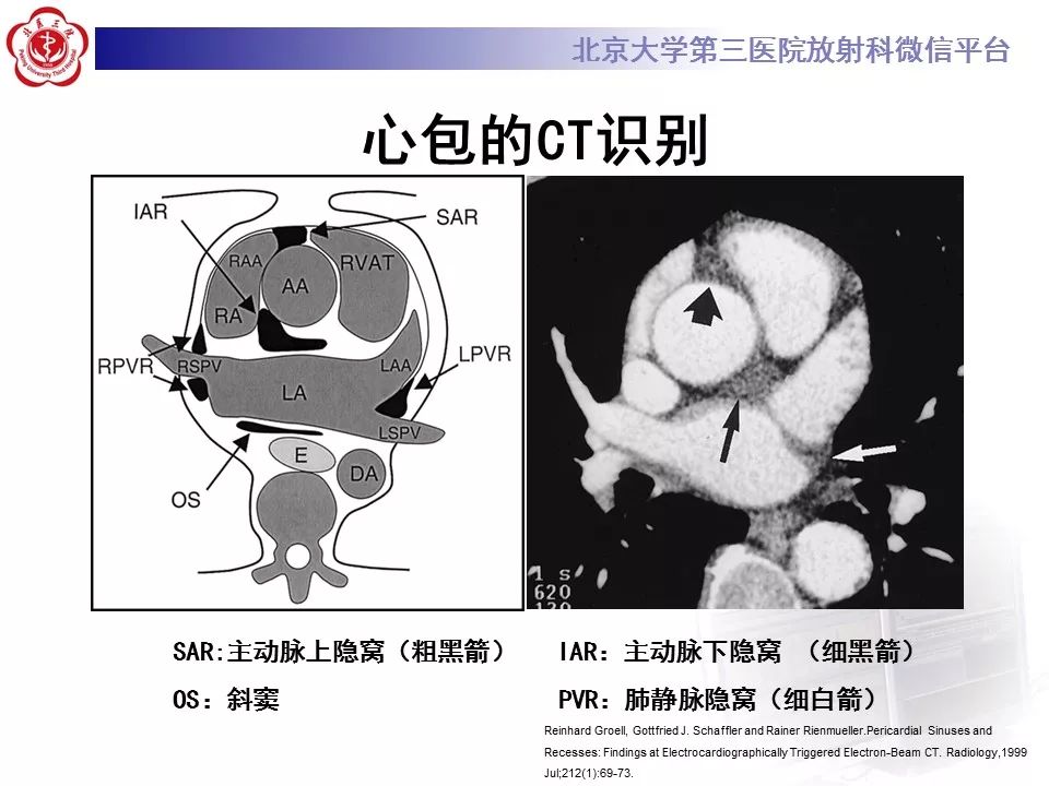 心包窦及心包隐窝的解剖结构