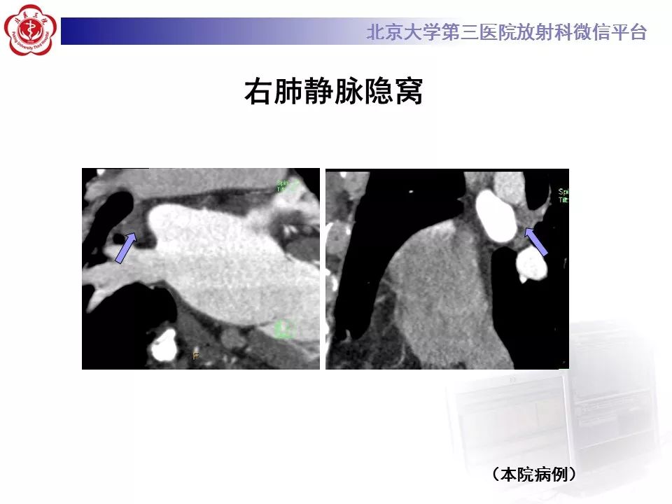 心包窦及心包隐窝的解剖结构