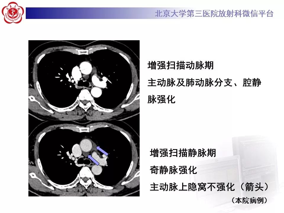 心包窦及心包隐窝的解剖结构