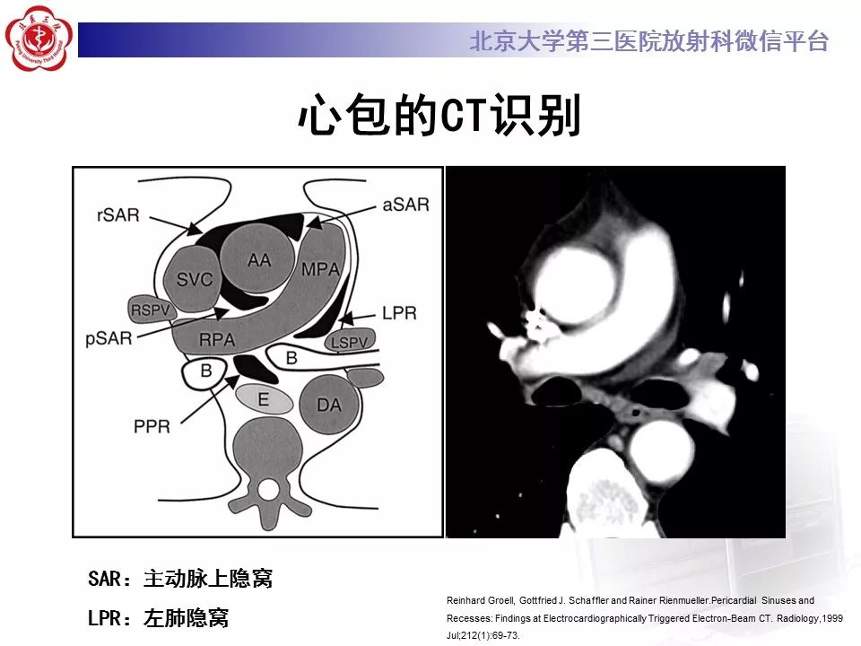 心包窦及心包隐窝的解剖结构