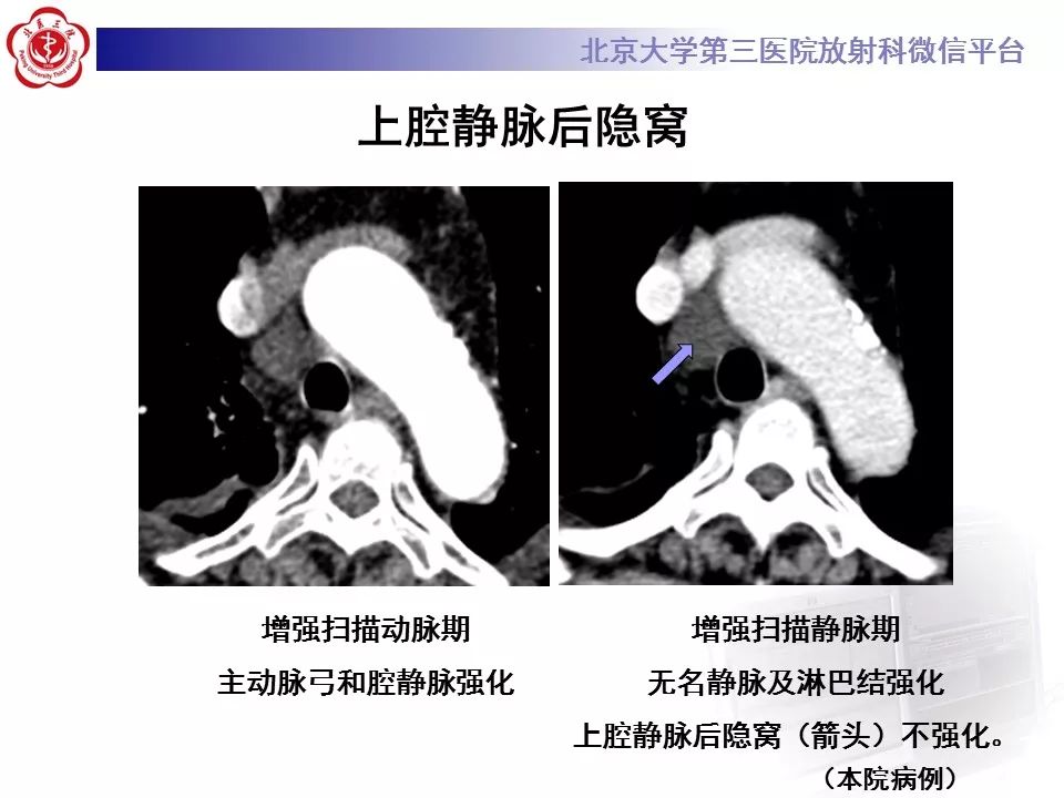 心包窦及心包隐窝的解剖结构