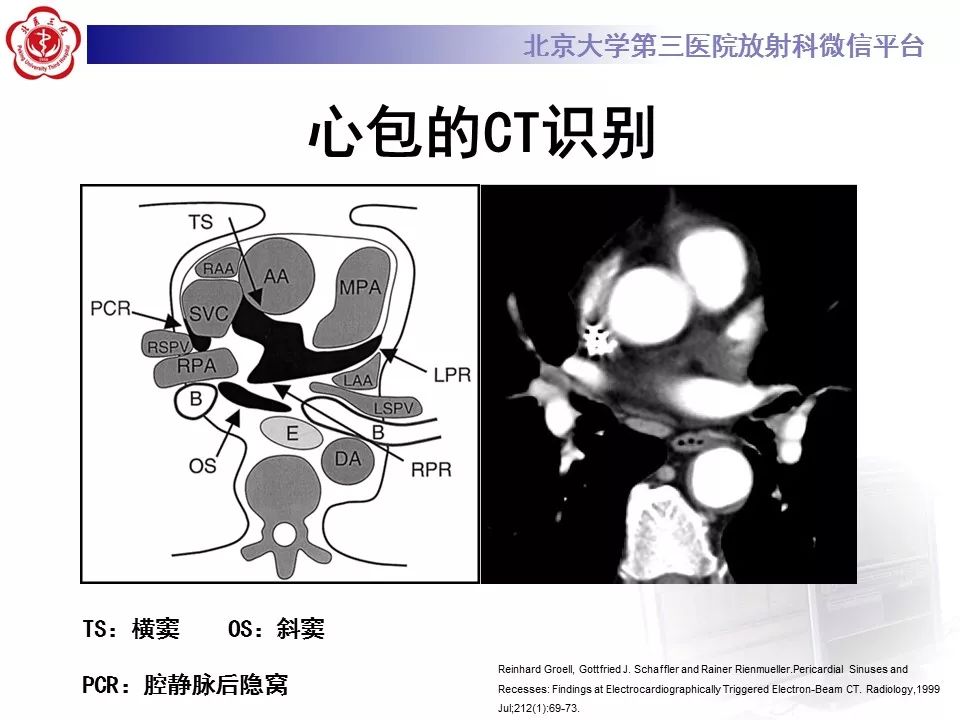 心包窦及心包隐窝的解剖结构