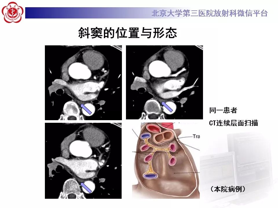 心包窦及心包隐窝的解剖结构