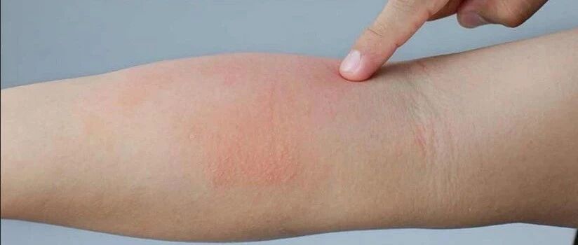 一图读懂 | 儿童湿疹护理