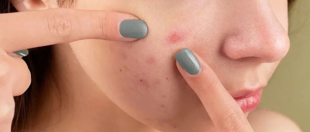 早就成年了，为什么还冒痘？