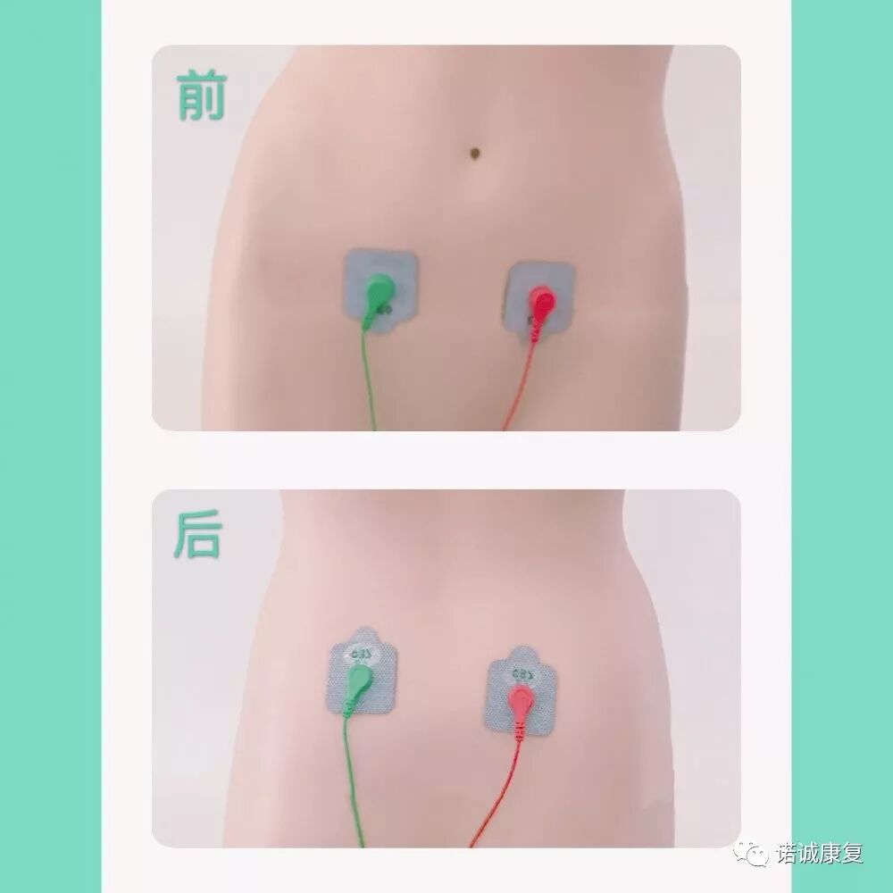 电极贴片怎么用常用处方电极片贴法_https://www.jmylbn.com_新闻资讯_第4张