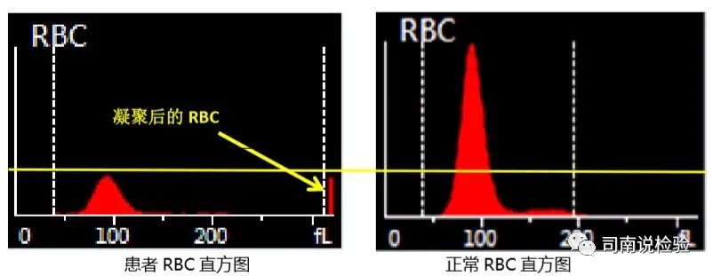 rbc直方图怎么看知识点058：说说红细胞直方图_https://www.jmylbn.com_新闻资讯_第17张