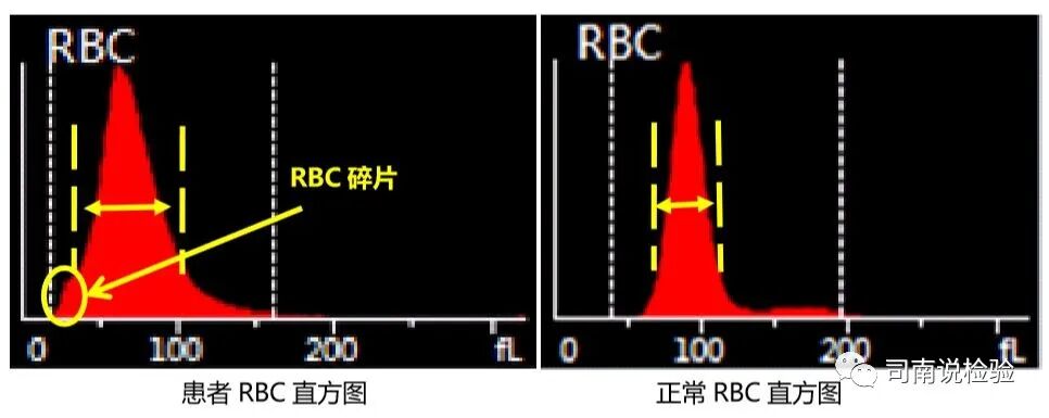 rbc直方图怎么看知识点058：说说红细胞直方图_https://www.jmylbn.com_新闻资讯_第20张