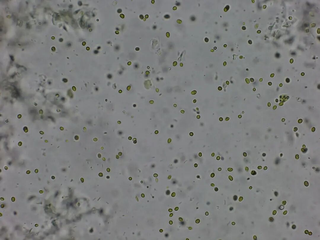 粪便常规仪器怎么用形态学142：粪便-真菌（白色念珠菌）（仪器辅助判断）_https://www.jmylbn.com_新闻资讯_第6张