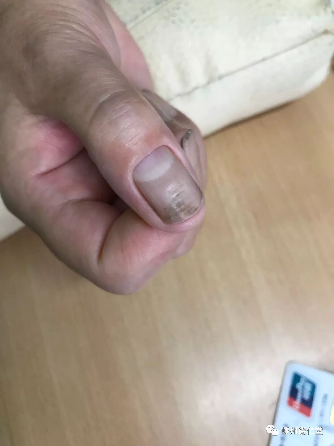 手足癣甲癣的防治