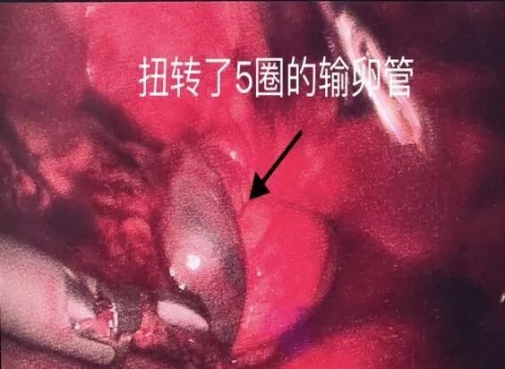 什么是结扎速血管闭合惊！9岁女孩卵巢囊肿蒂扭转1800度！市二妇科团队紧急手术保卵巢！_https://www.jmylbn.com_新闻资讯_第6张