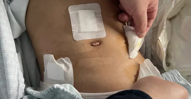 什么是结扎速血管闭合惊！9岁女孩卵巢囊肿蒂扭转1800度！市二妇科团队紧急手术保卵巢！_https://www.jmylbn.com_新闻资讯_第4张