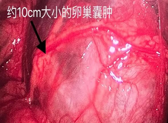 什么是结扎速血管闭合惊！9岁女孩卵巢囊肿蒂扭转1800度！市二妇科团队紧急手术保卵巢！_https://www.jmylbn.com_新闻资讯_第7张