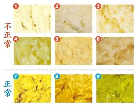 新突破 | 新生儿干血斑实现胆道闭锁精准早筛