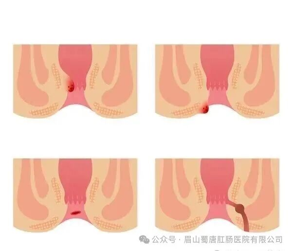 痔疮患者请管住嘴！这几种食物是“加重剂”，再馋也要忍