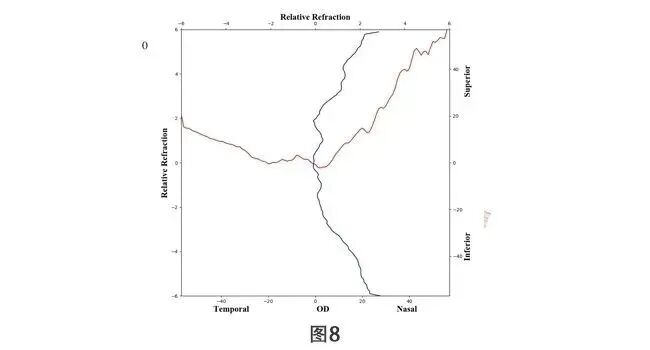 助力近视防控，我院眼科引进MRT多光谱屈光地形图