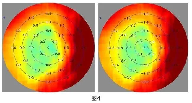 助力近视防控，我院眼科引进MRT多光谱屈光地形图