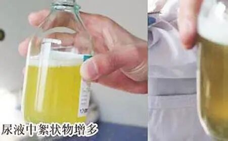 poct什么意思三大常规检查之一的尿常规，检查单你看的懂吗？了解一下每个项目代表的意思吧！_https://www.jmylbn.com_新闻资讯_第11张