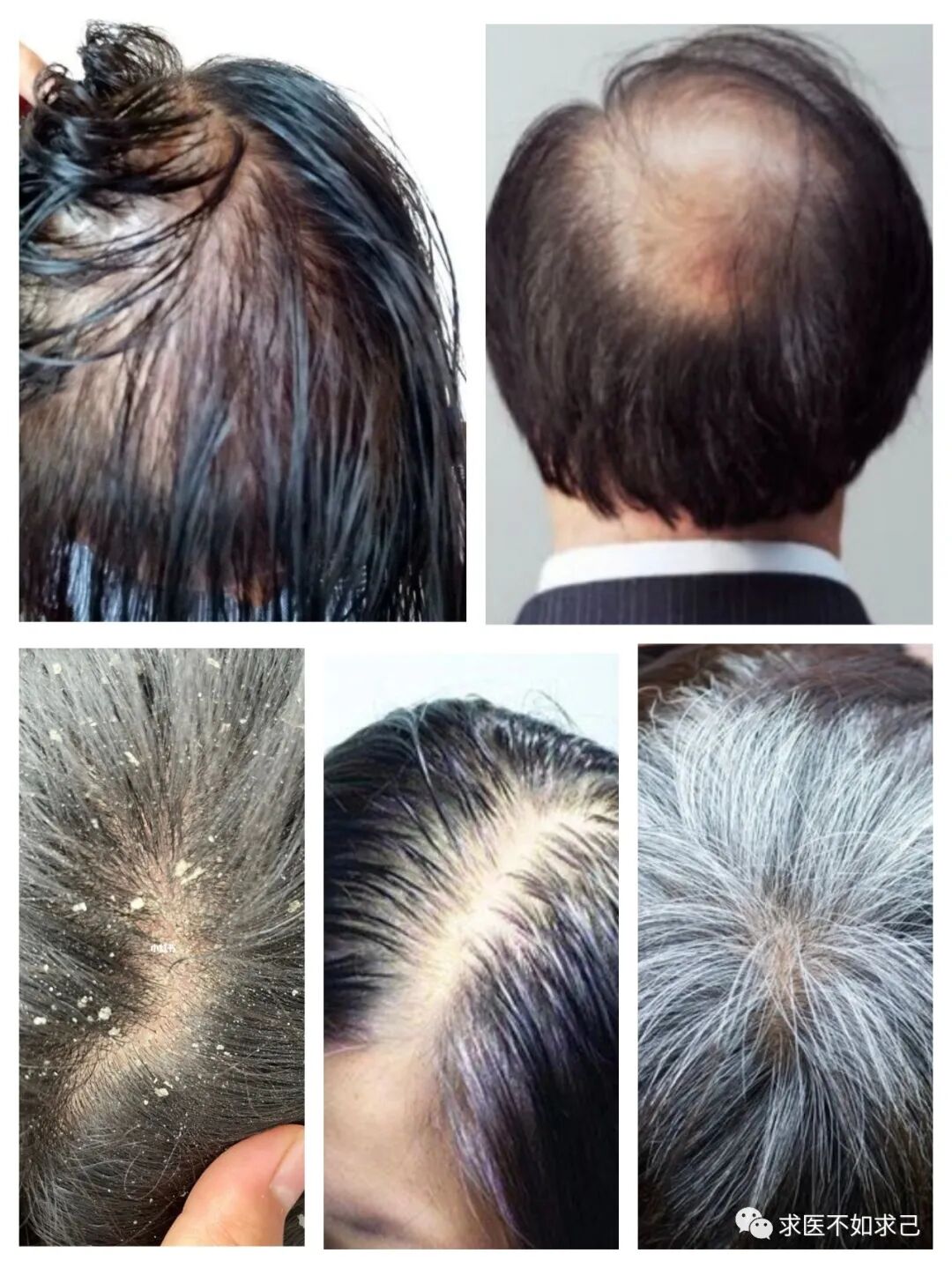 脱头发、白头发、头发爱出油、头皮痒、头屑多是什么原因，该如何拍？