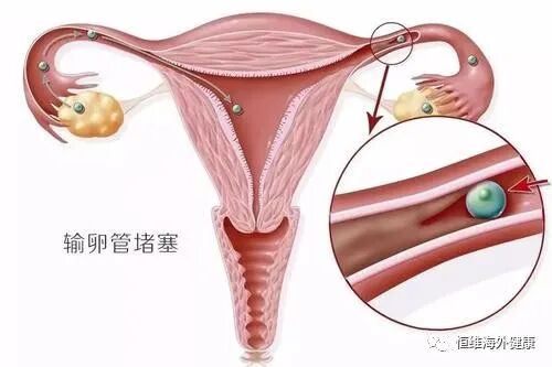 做试管婴儿，输卵管积水是「切」还是「留」？！