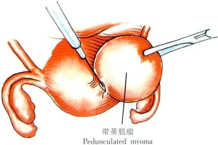 当试管婴儿碰上子宫肌瘤，试管之路该何去何从！