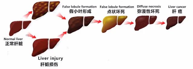 b超md是什么意思肝脏B超报告单常见术语全在这里！_https://www.jmylbn.com_新闻资讯_第2张