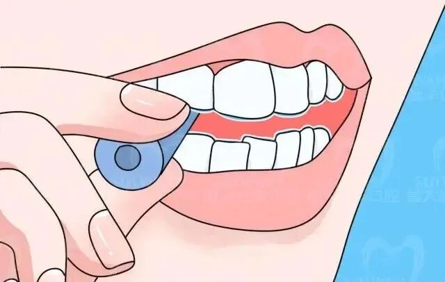 牙科材料硅胶怎么用【口腔科普】“小小咬胶”却是隐形矫治的助力神器！_https://www.jmylbn.com_新闻资讯_第7张