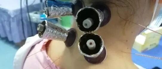 集针刺、艾灸、玉疗于一体的温针玉灸了解一下