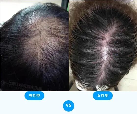 脂溢性脱发只发生于男性吗，脂溢性脱发是怎么回事？