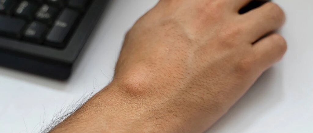 手腕上长了个包是怎么回事？【腱鞘囊肿】要开刀吗？